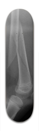 Kaden Broken Femur