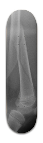 Broken Femur 2